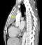 Axial and sagital reconstruction from a contrast enhanced chest CT at the level of the ascending aorta demonstrates an <strong>anterior medastinal mass(M)</strong>. The mass shows a small regions of heterogeneity with a low attenuation region, and abuts the anterior aspect of the pericardium. There is a lobulated contour that abuts the lung . At surgery, the thymoma was found to invade the medaistinal fat as well as the right lung, without invasion into the aorta or other mediastinal vessels .